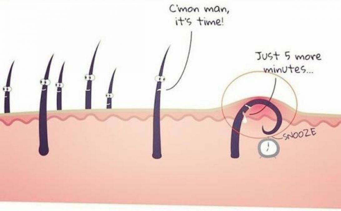 Treating and Preventing Ingrown Pubic Hair fast