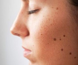 Adopt this home remedy to get rid of unwanted moles