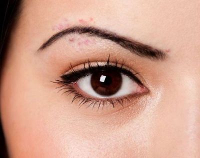 The Real Reason You Have Acne Between Your Eyebrows