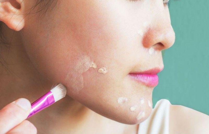 No Need to Hide Blemishes with Makeup – Just Follow These Remedies