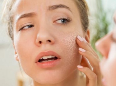 Do you suffer from dry skin? Adopt these winter remedies to find relief