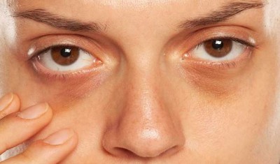 How to Get Rid of Dark Circles Under the Eyes with These Tricks