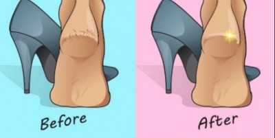 If the heels are cracked then apply ​homemade crea