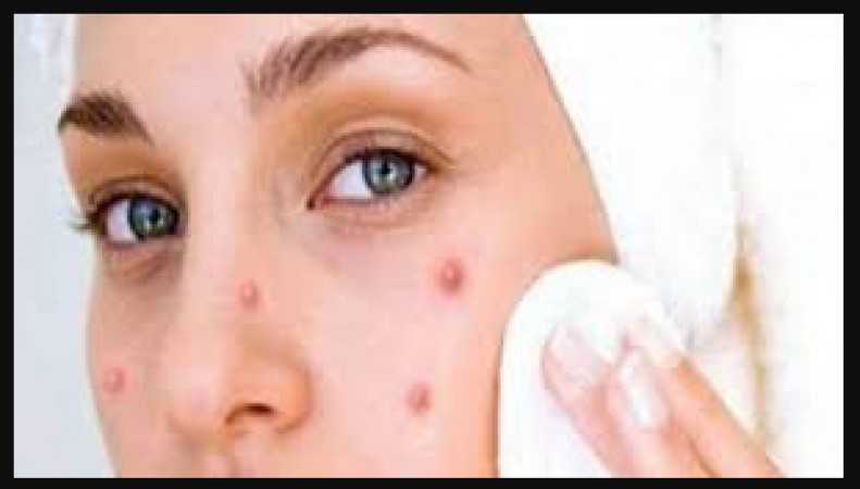 These patterns increase the problem of pimples