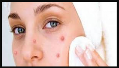 These patterns increase the problem of pimples
