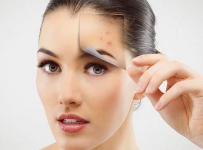 Adopt these methods to get rid of pimples