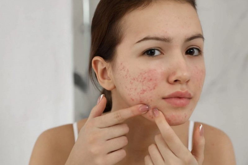 Clear Acne in a Snap: Use This One Thing