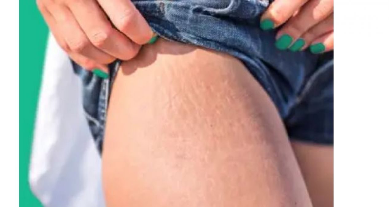 Remove stretch marks from thighs so take these home remedies