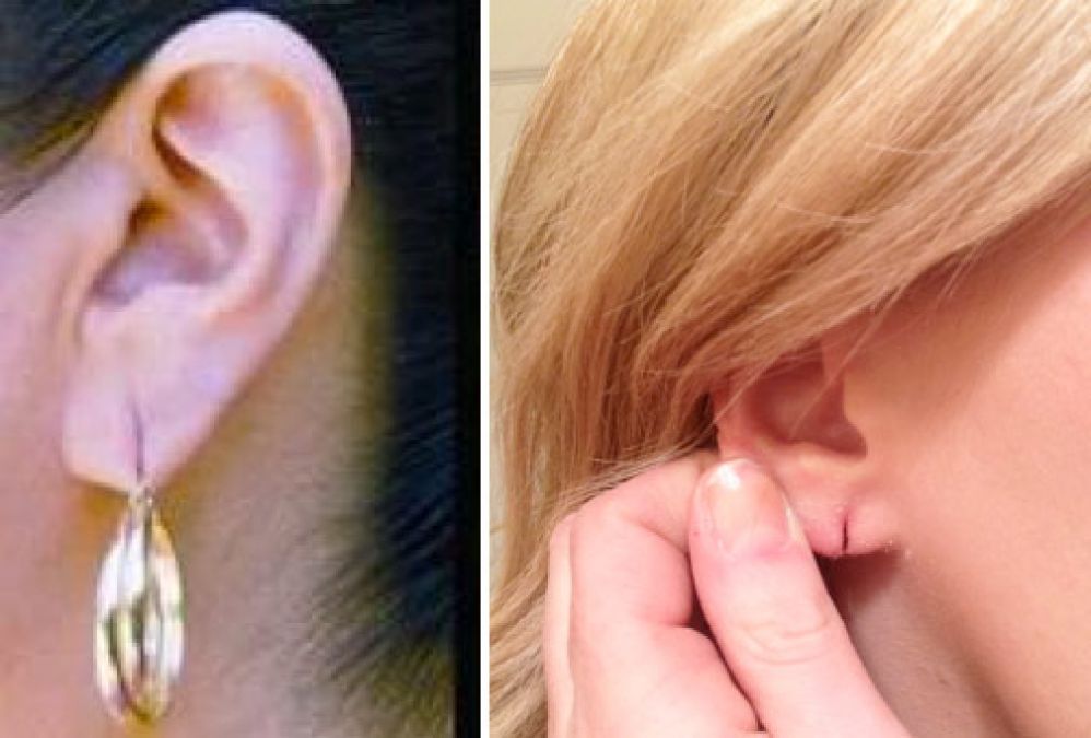 Earlobes can be repaired even without surgery; here's how!