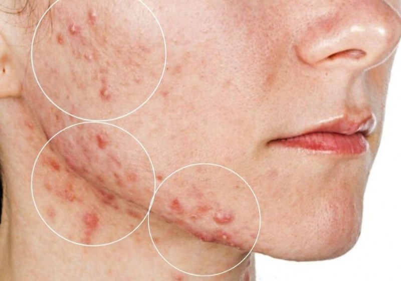 Download this app on your mobile today to understand why acne occurs on your face