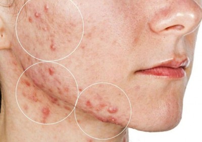 Download this app on your mobile today to understand why acne occurs on your face
