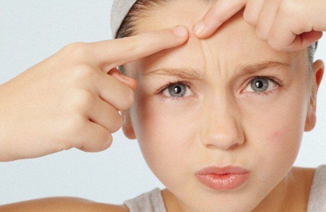 Adopt this habit to avoid acne on your face