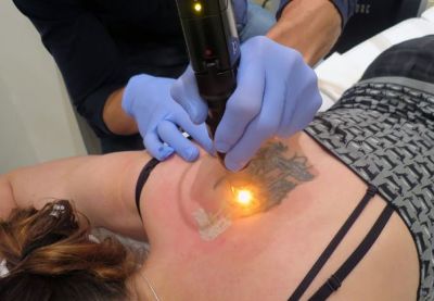 Follow these tips to take care of the skin after Tatoo removal!