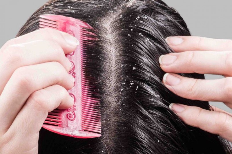 Follow These Methods to Reduce Stubborn Dandruff