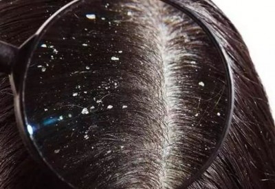Dandruff Will Disappear with This One Simple Trick