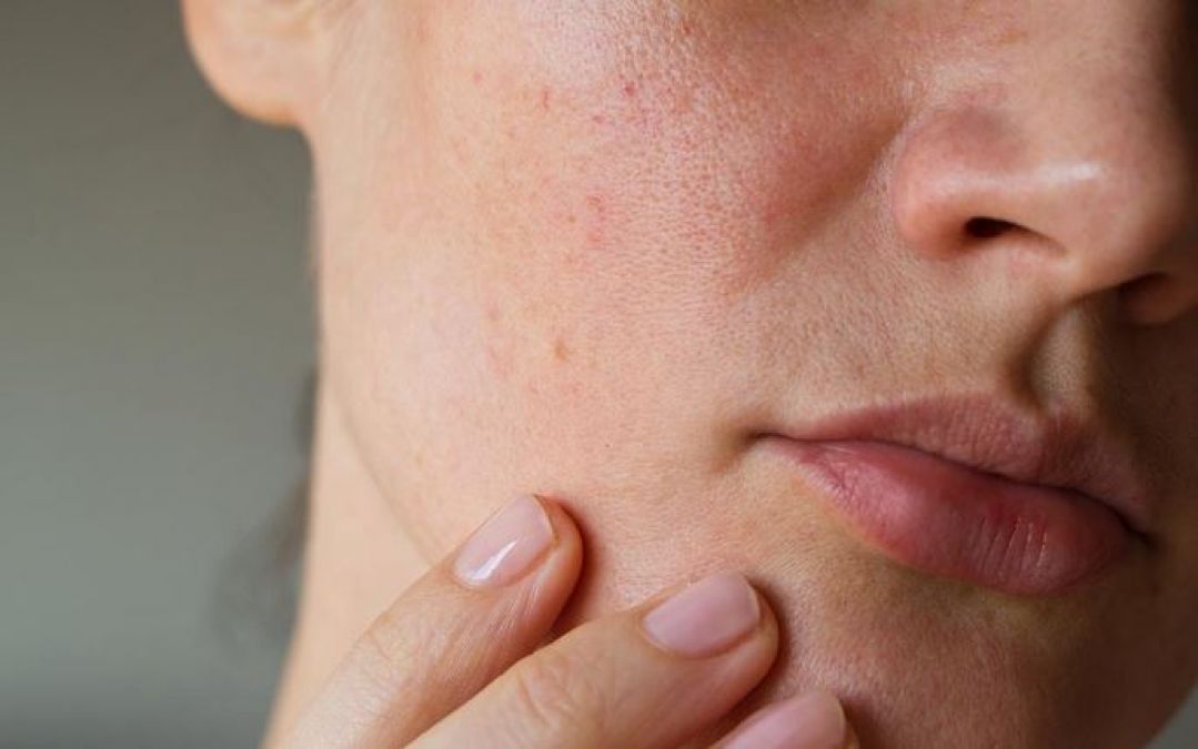 Tips To Remove Deep Acne Scars or Pimple Holes on Face