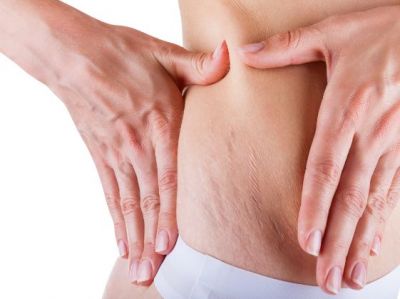 Fast and simple home remedies to get rid of pregnancy stretch marks