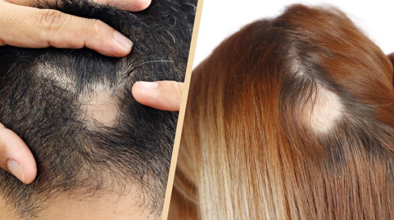 Struggling with Hair Loss? Check Your Haircare Habits
