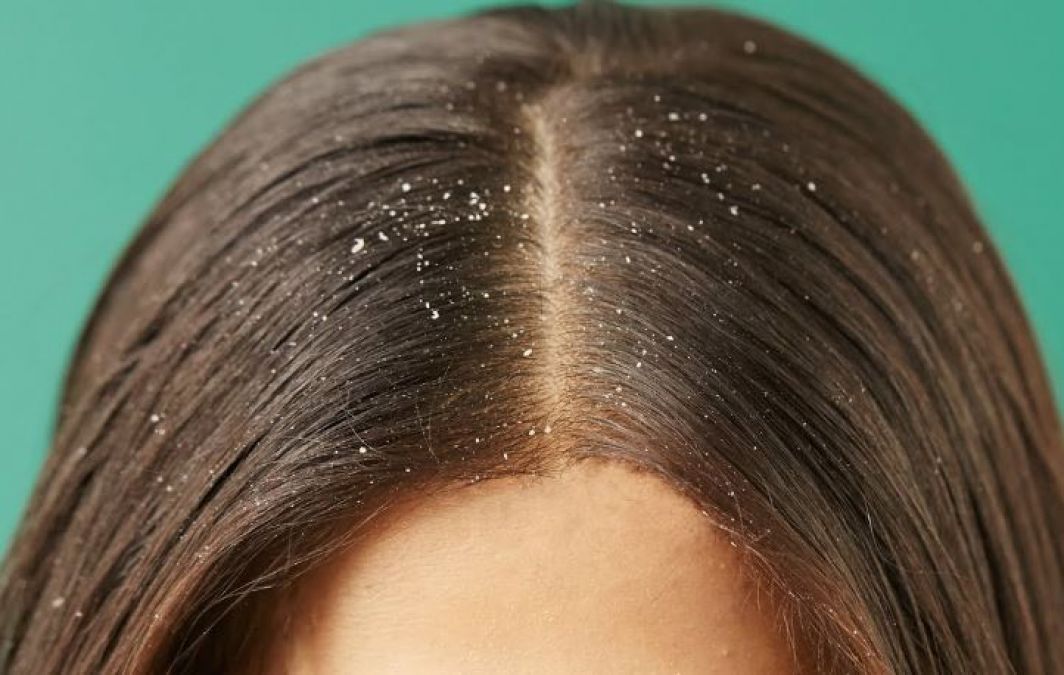 Itchy Scalp & Dandruff Remedies For This Monsoon