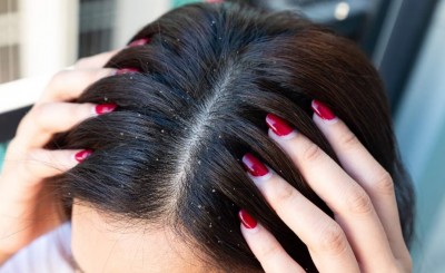 How to Get Rid of Dandruff: Follow These Home Remedies
