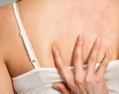 Can't Wear Backless Blouses and Dresses Due to Pimples on Your Back? Try These Remedies to Get Rid of Them