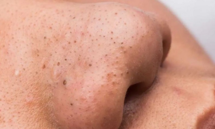 Follow These 5 Home Remedies to Remove Blackheads from Your Face