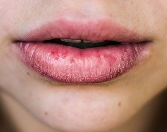 Have Your Lips Become Dry and Lifeless? Follow These Home Remedies