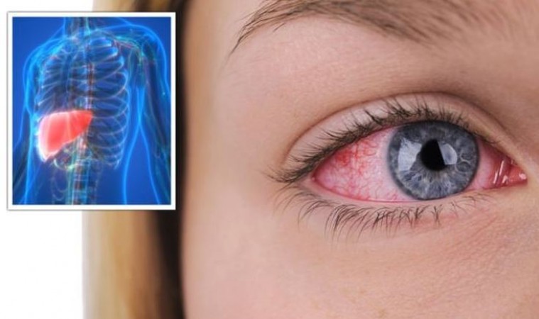 How to Identify These 5 Signs of Fatty Liver Around the Eyes - Do Not Ignore