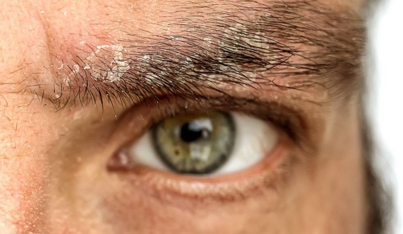 If You Are Troubled by Eyebrow Dandruff, Get Rid of It Like This