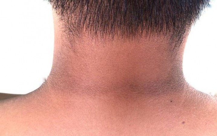 Black neck will shine in minutes, just follow these 5 home remedies