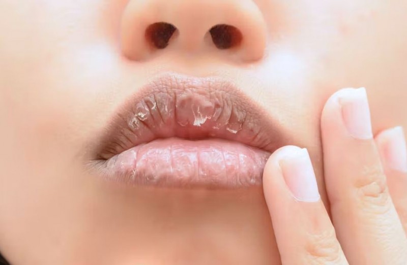 Are Your Lips Dry Again and Again? Here Might Be the Reason