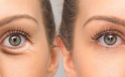 If Dark Circles and Wrinkles Have Formed Under the Eyes, Follow These Tricks to See Results in a Few Days