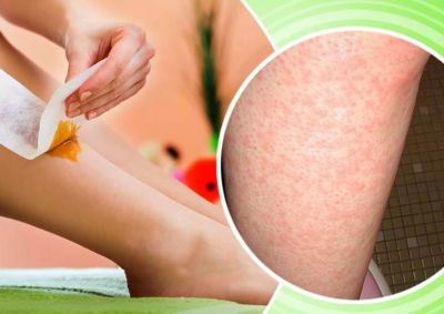 Do You Also get bumps after Waxing, Follow These Tips to treat well