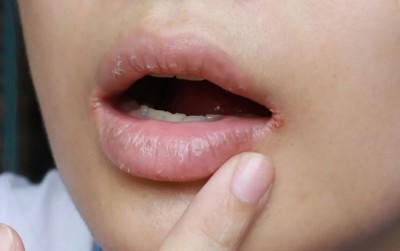 Do You Also Have Frequent Cracked Lips? Be Careful, This May Be the Reason