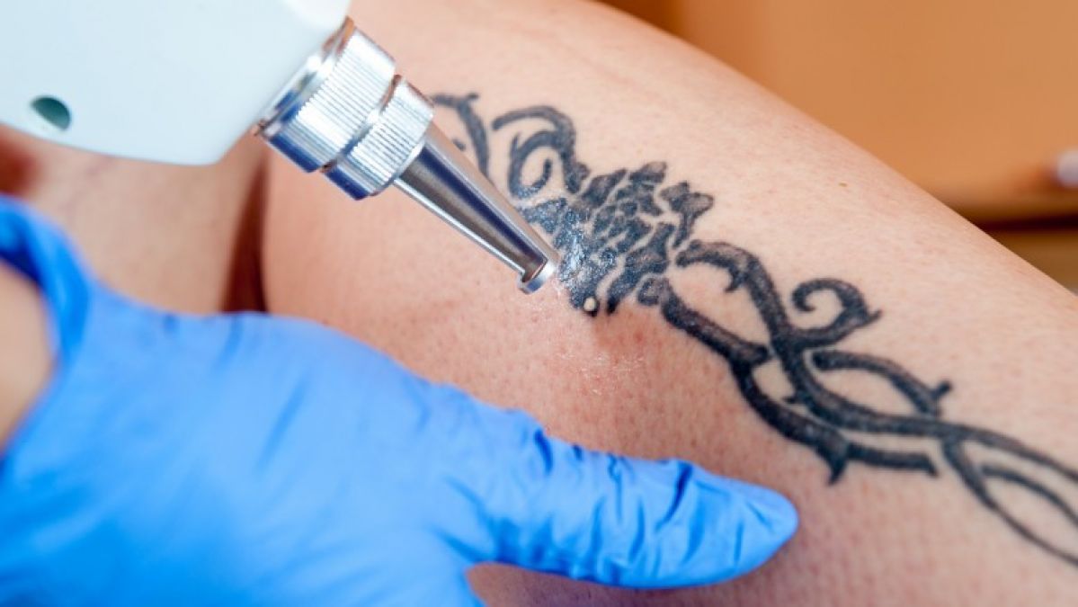 Are you going for Tattoo removals? Know some important thing before doing so