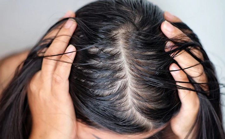 How to Get Rid of Oily Hair: Troubled by Greasy Hair? Try These Remedies