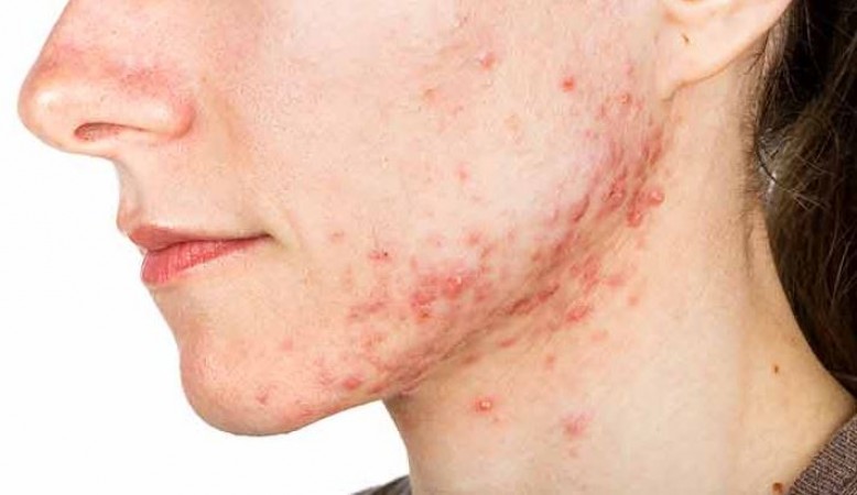 What Is Cystic Acne? Understanding Its Dangers to the Skin