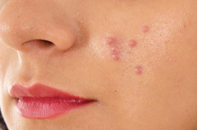 How to Understand the Causes of Stubborn Pimples
