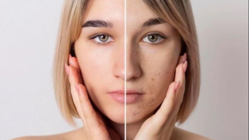 Follow These Remedies to Get Relief from Pigmentation