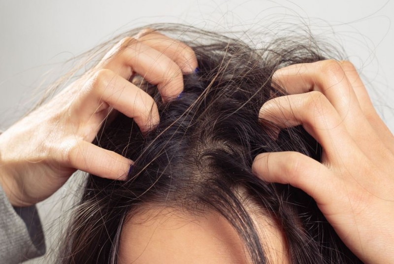 Combating Winter Scalp Itch: Effective Tips for Relief