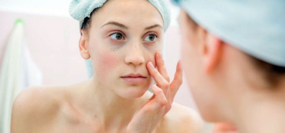Are you also bothered by dark circles and follow these special tips