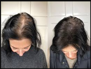 If you are struggling with the problem of severe hairfall, this treatment will provide relief