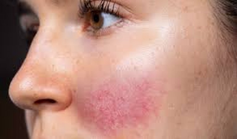 Have you been a victim of cosmetic allergy?