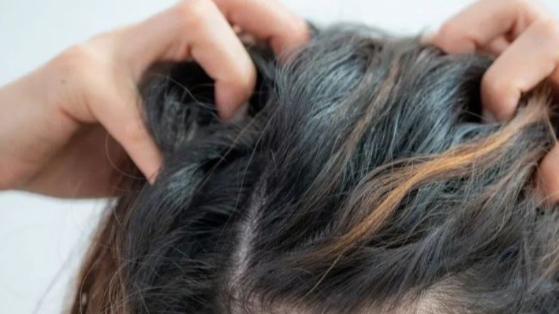 Now the problem of dandruff will end from the root