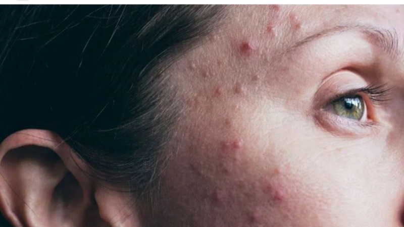 What is the difference between acne and pimple?