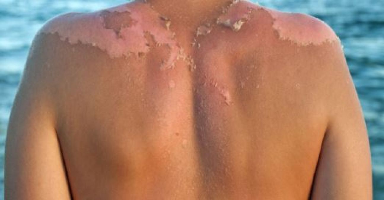 Sun can cause cancer, if these symptoms appear in body, then do this way to protect it