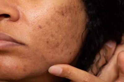 If You Are Troubled by Black Spots, Try This Trick to Get Rid of Them