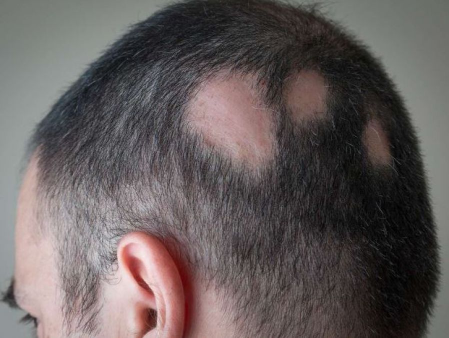 Alopecia Areata & Hair Loss: Signs, Symptoms and Treatment Options