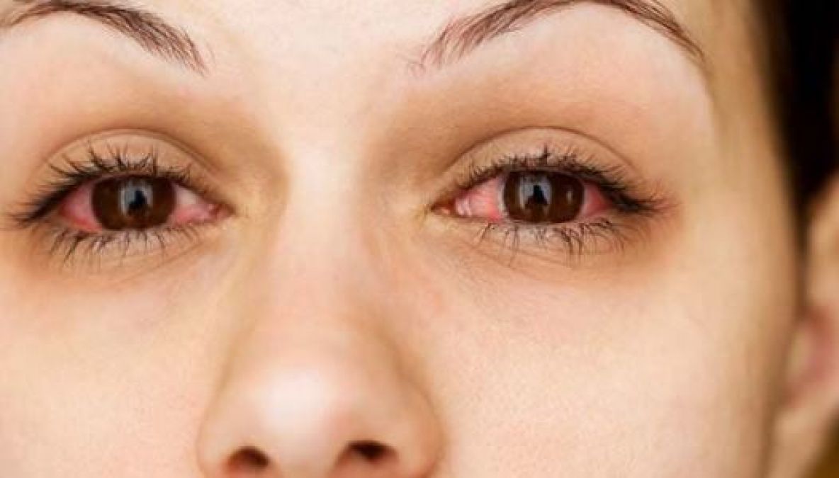 Home Remedies for Eye Infections during Monsoon