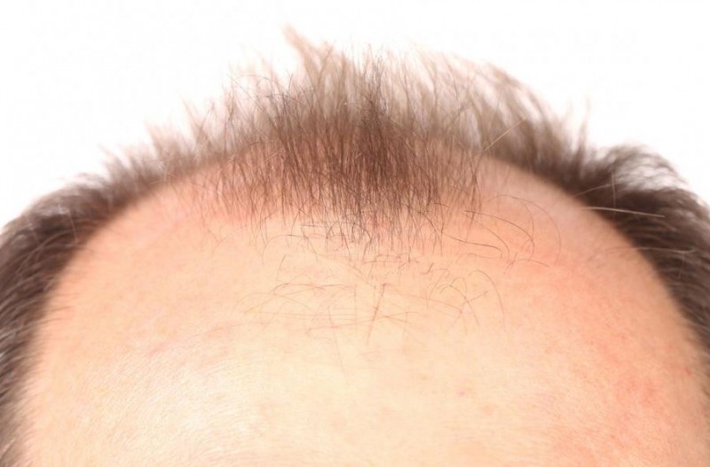 Shocking Research Reveals: One Habit That Increases Baldness!
